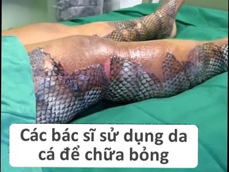 Kỳ lạ phương pháp chữa bỏng bằng da cá rô