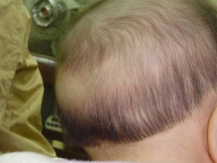 Cách điều trị rụng tóc vành khăn ở trẻ nhỏ đơn giản và chuẩn nhất theo bác sĩ tư vấn