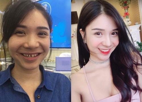 Loạt ảnh trước - sau của sao Việt cho thấy sức mạnh ghê gớm của việc chỉnh răng