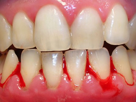 Chảy máu chân răng: Dấu hiệu cảnh báo bệnh ung thư