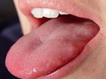Đừng nhầm lẫn ung thư lưỡi và nhiệt miệng-4