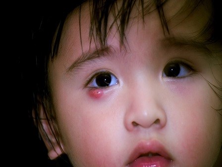 Bác sĩ chỉ cách chữa lẹo, chắp ở mắt cho trẻ bằng rau xanh