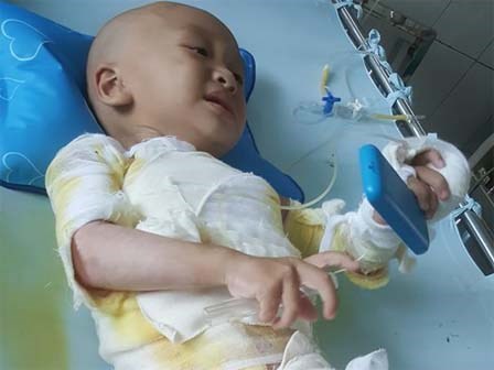 Đau đớn bé trai 18 tháng tuổi bị bỏng toàn thân vì ngã vào nồi nước nóng ở đám cưới