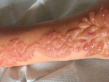 Xăm henna ở tay trong chuyến du lịch Ai Cập, bé gái nhận hậu quả khủng khiếp