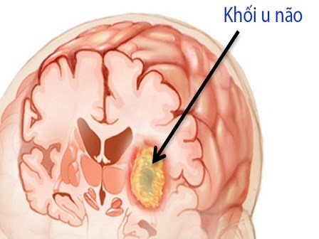 8 dấu hiệu tố cáo có khối u đang lớn dần trong não bạn