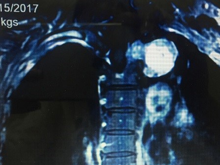 Tuỷ sống mọc u to như quả cam