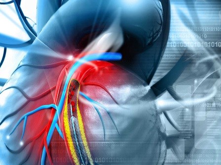 Bệnh mạch vành có thể khiến bạn nhồi máu cơ tim: Những triệu chứng phải để ý ngay kẻo muộn