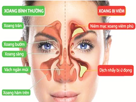 Cách đơn giản tự chữa viêm xoang