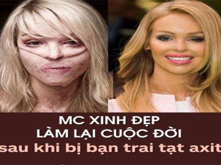 MC xinh đẹp làm lại cuộc đời sau khi bị bạn trai tạt axit
