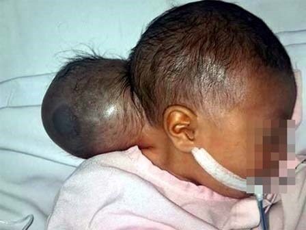 Bé gái mang khối u quái dị trông như có 2 đầu bị mẹ bỏ rơi khi đưa đến bệnh viện một ngày