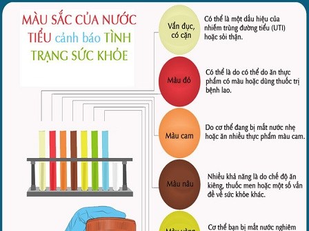 Màu sắc của nước tiểu cảnh báo tình trạng sức khỏe của bạn