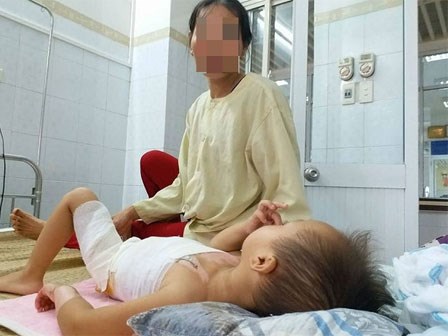 Bé gái 23 tháng tuổi bị bỏng nặng vì bà pha mỳ tôm để cạnh mép bàn