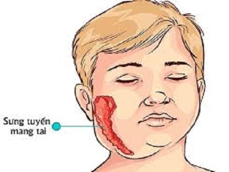 Mẹo chữa bệnh quai bị hiệu quả