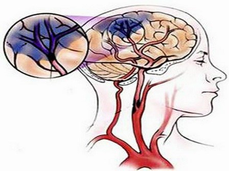 Làm sao biết bị thiếu máu não?