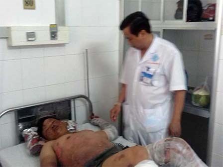 Bếp cồn cháy dữ dội, 11 người đang ăn tiệc cưới bị bỏng