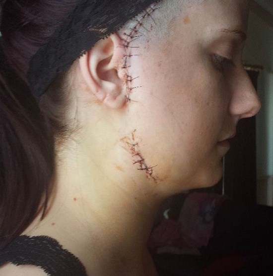 Cảnh báo căn bệnh nguy hiểm từ bà mẹ trẻ bị liệt cơ hàm chỉ sau một đêm