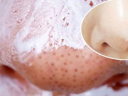 Cách trị mụn cám, mụn đầu đen với kem đánh răng siêu đơn giản