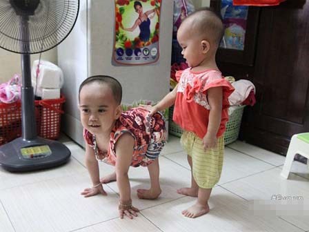 Em bé đi bằng “4 chân”, sống nhờ vào những chiếc bao cao su và băng vệ sinh
