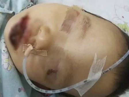 Người lớn bất cẩn, cô bé 2 tuổi bị 