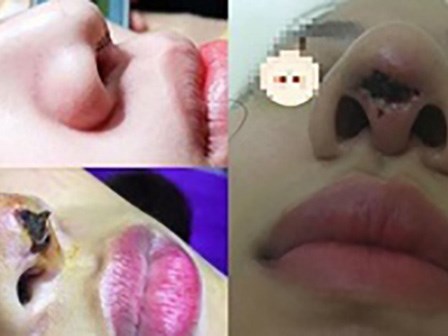 'Cạn lời' về nguyên nhân xuất hiện thêm 'lỗ mũi thứ 3' sau phẫu thuật nâng sụn tự thân của cô gái trẻ