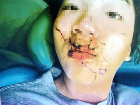 Choáng váng trong ngày hành kinh, bé gái 11 tuổi ngã vào kính trường học, khuôn mặt bị thương nặng nề
