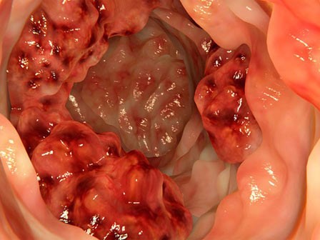 Giáo sư đầu ngành tiêu hoá: Hãy nhớ các dấu hiệu sau để không chết vì ung thư đại tràng