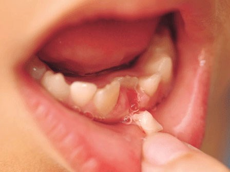 Bác sỹ nha khoa cảnh báo 2 trường hợp bố mẹ không nên tự nhổ răng sữa cho con tại nhà
