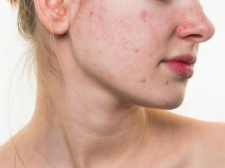 9 dấu hiệu bước đầu cho thấy bạn đang bị kích ứng với mỹ phẩm đang dùng