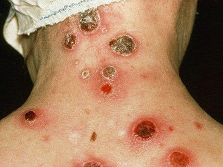 4 bệnh tình dục nguy hiểm khiến bạn ngừng ngay ý định