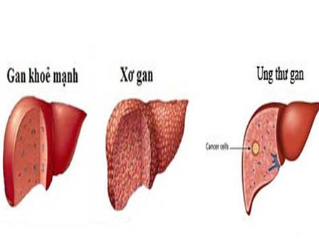 Bệnh gan tại Việt Nam - thực trạng đáng báo động