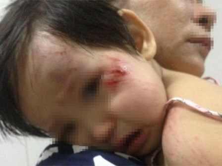 Xác định nam thanh niên tông bé gái 11 tháng tuổi trầy xước mặt rồi bỏ chạy