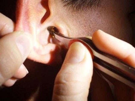 Cận cảnh màn lấy ráy tai siêu khủng khiến người xem phải