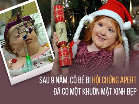 Cũng mắc hội chứng Apert, trải qua 16 cuộc phẫu thuật, cô bé này đã có khuôn mặt xinh đẹp