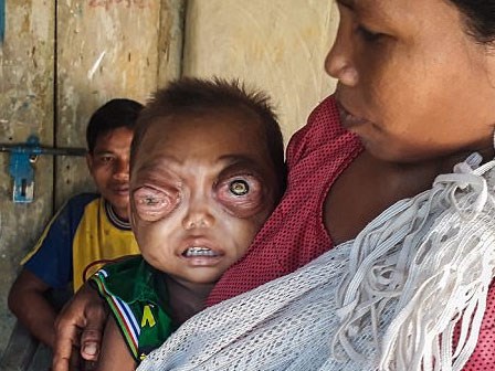 Bé 2 tuổi mắc bệnh lạ khiến mắt lồi như muốn nổ tung