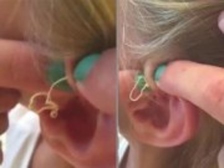 Hãi hùng pha nặn mụn bọc, nhân mụn bắn ra như sợi mỳ