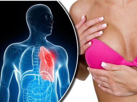Triệu chứng nhận biết 3 bệnh ung thư phổ biến nhất
