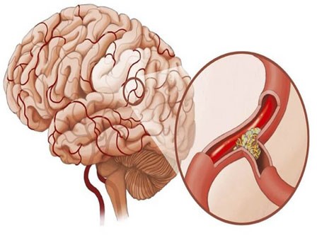 Mạch máu thông thì cơ thể khỏe: GS nổi tiếng khuyên bạn 5 điều nên làm để tránh tử vong