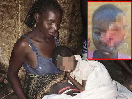 Bé gái mất nửa mặt vì bệnh khô sắc tố da