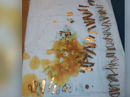 Tưởng khối u dạ dày, bác sĩ kinh hãi chứng kiến thứ này trong bụng bệnh nhân