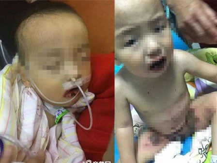 Tưởng nhầm chất tẩy là đường trắng, bé trai lấy ăn và nhập viện trong tình trạng nguy kịch