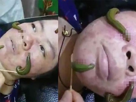 Phương pháp trị mụn chắc không bạn gái nào dám thử: Dùng đỉa hút sạch mụn trên gương mặt