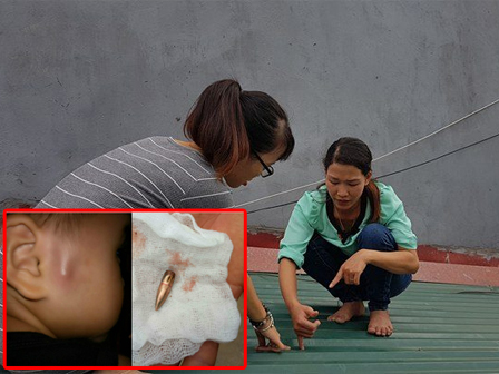 Đang đứng trước cửa nhà, người phụ nữ 32 tuổi bị viên đạn ghim thẳng vào mắt, suýt mù vĩnh viễn-7