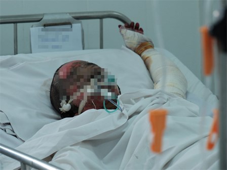 Lụy tình, chồng cũ tạt xăng châm lửa đốt vợ và người yêu mới nguy kịch