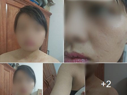 Từ chối nộp hết tiền kiếm được hàng tháng cho mẹ chồng, người phụ nữ bị nhà chồng đánh thâm tím khắp người