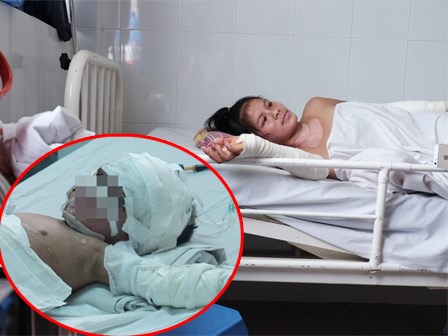 Nến rớt xuống bình xăng dưới giường, hai mẹ con thai phụ bỏng nặng, chồng chưa cưới ôm tiền ủng hộ bỏ trốn