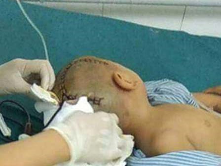 Bé 3 tuổi bị chấn thương sọ não ở trường mầm non