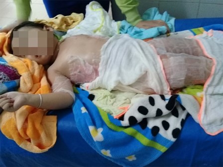 Dự tiệc nhà hàng, bé 3 tuổi bỏng nặng vì ngã vào nồi chè