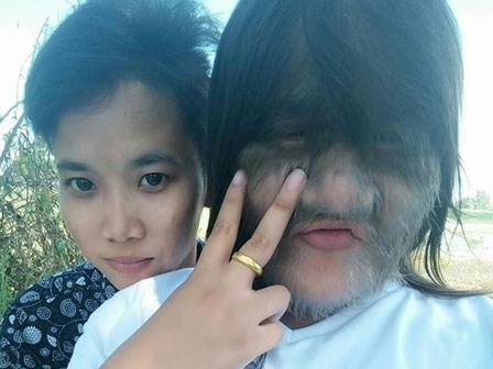 Đau khổ cả đời cuối cùng 'cô gái người sói' đã tìm được tình yêu đích thực