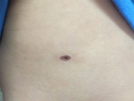 2 trẻ nguy kịch cùng có vết đốt lạ ở bụng