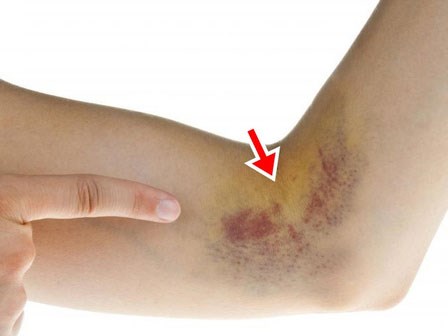 Bầm tím trên da: Chớ coi thường vì đây có thể là dấu hiệu các bệnh rất nguy hiểm